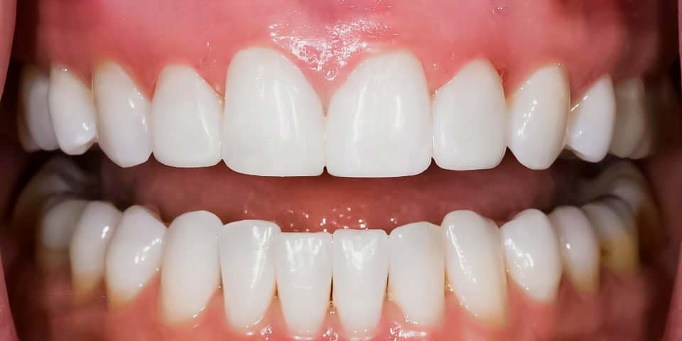 before-after