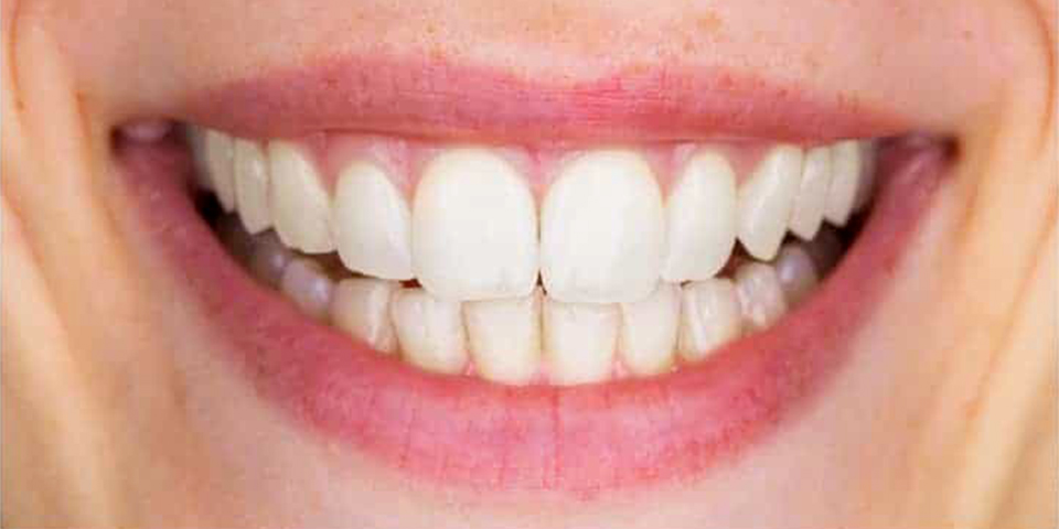 before-after