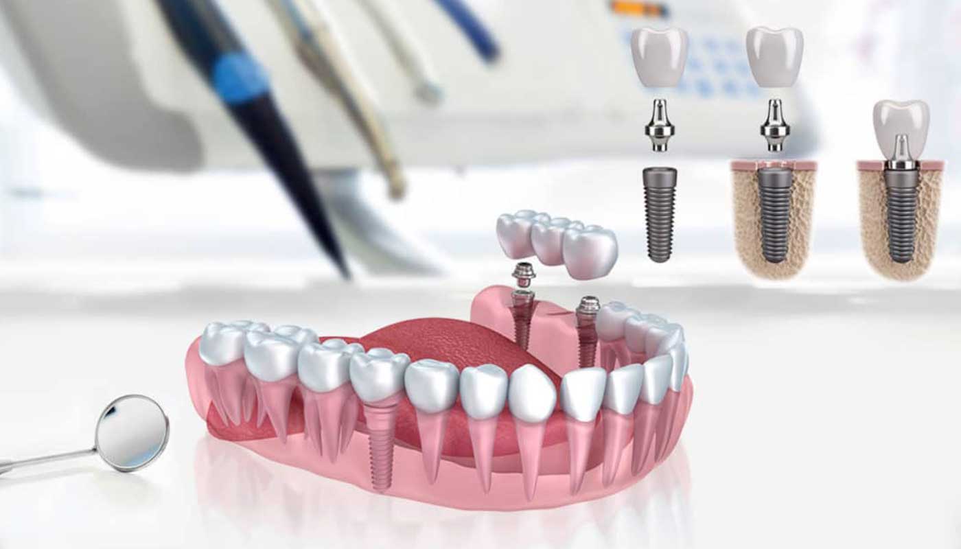 Implants dentaires